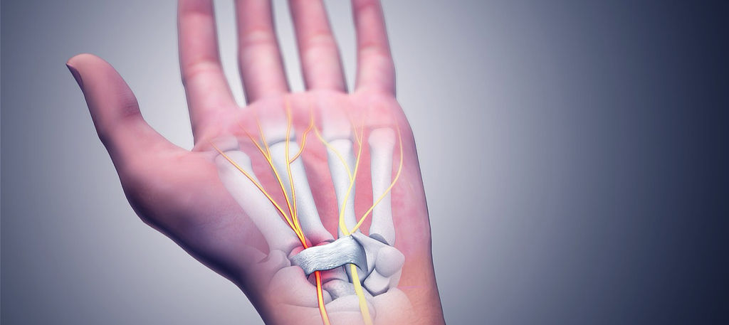 Carpal Tunnel Syndrome  Manchester NH